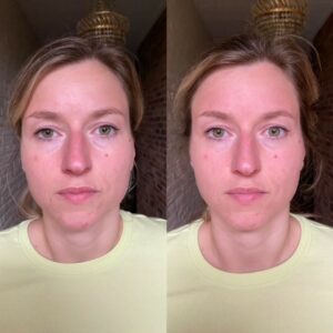 voor en na resultaat natuurlijke facelift