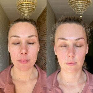 voor en na resultaat holistische facelift