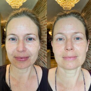 voor en na resultaat natural facelift refelxology