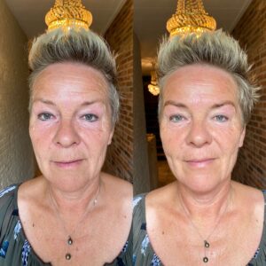 holistische facelift resultaat