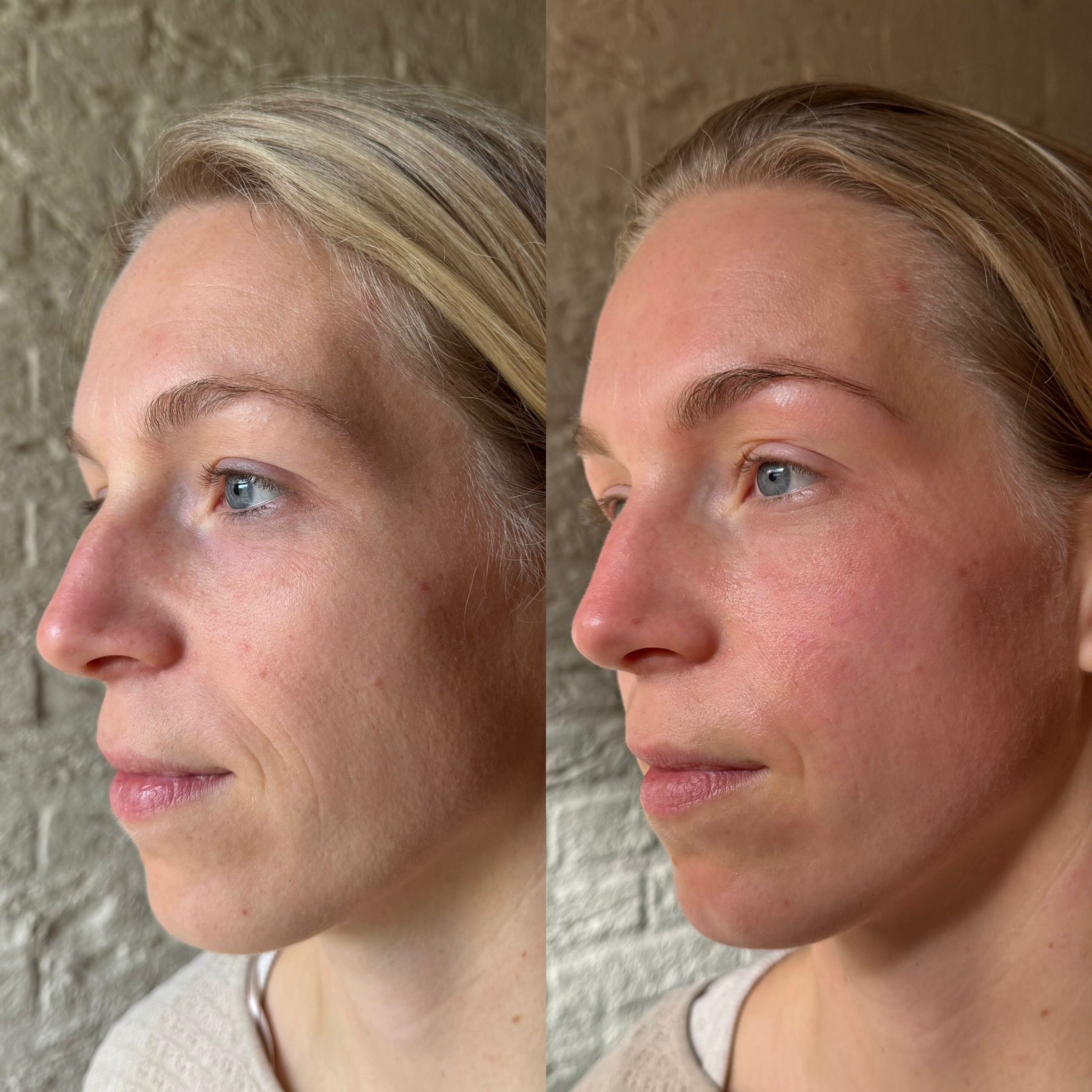 natural-facelift-voor-na.jpg